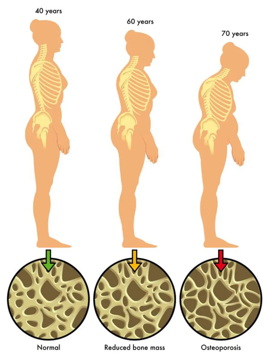 Reduce bone health cause osteoporosis